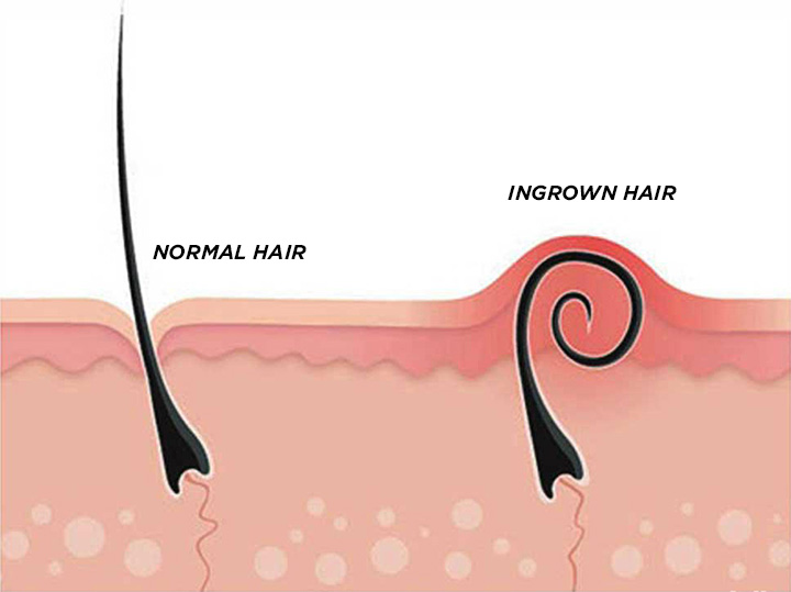 علت ایجاد موی زیرپوستی